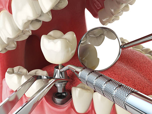 Best Emergency Denture Repair in Cotati, CA